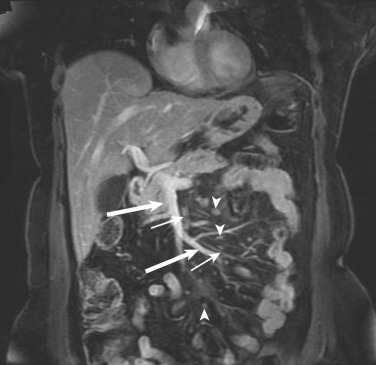 FIG 47-7, Normal anatomy of mesenteric vessels and lymph nodes. Contrast-enhanced fat-saturated coronal MRI shows enhanced branches of the SMV (large arrows) and SMA (small arrows). Arteries are smaller and run parallel to veins. Along with these vessels, normal mesenteric nodes (arrowheads) are scattered as round or ovoid structures.