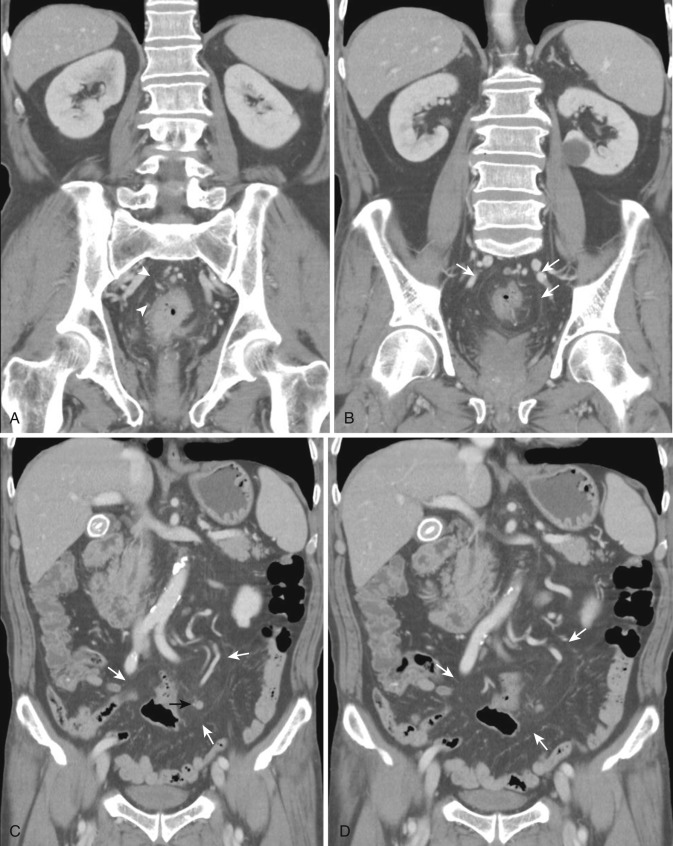 FIG 47-8, Sigmoid colon cancer. A to D, Coronal reformatted CT shows focal enhanced wall thickening in the upper rectum (arrowheads) with infiltration surrounding the sigmoid mesocolon. Small lymph node is noted on the sigmoid mesocolon (black arrow). The sigmoid mesocolon can be easily traced on coronal reformatted CT (arrows).