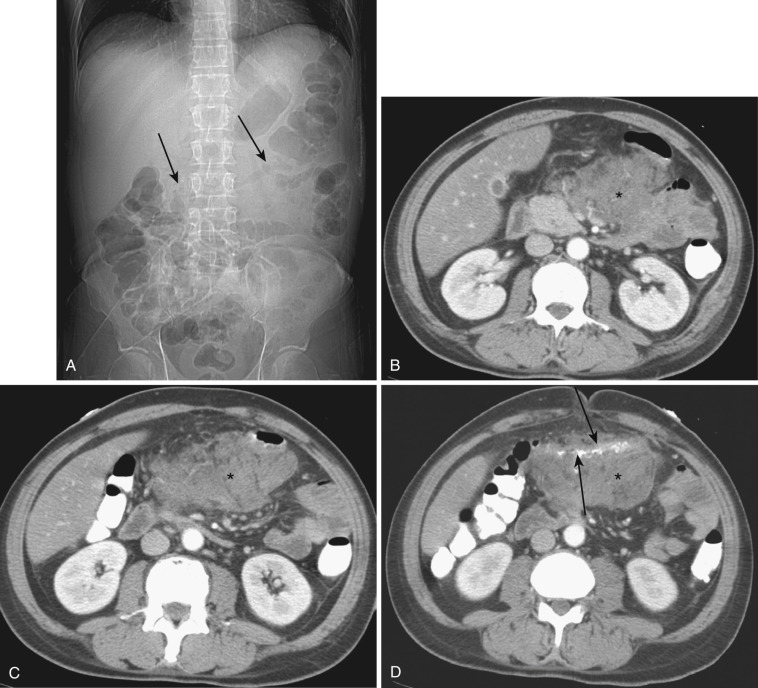 FIG 47-9, Acute pancreatitis. A, CT scout image shows sharply demarcated absence of colonic air (arrows) at midsegment of the transverse colon owing to involvement of pancreatitis through the transverse mesocolon. B to D, Three consecutive axial CT images show a large phlegmonous inflammatory mass (asterisk) encircling a segment of transverse colon ( arrows in D ), which extends from the pancreas.