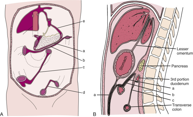 FIG 47-10, Schematic drawing of posterior attachment of small bowel mesentery, transverse and sigmoid mesocolon, and greater omentum. Coronal ( A ) and sagittal ( B ) views show the attachment of greater omentum and transverse mesocolon running parallel to each other—the greater omentum being shorter and superior to the mesocolon. These two peritoneal folds are loosely attached but not fused. Note the inverted V–shaped attachment of the sigmoid mesocolon. a, greater omentum; b, transverse mesocolon; c, small bowel mesentery; d, sigmoid mesocolon; e, gastrosplenic ligament.