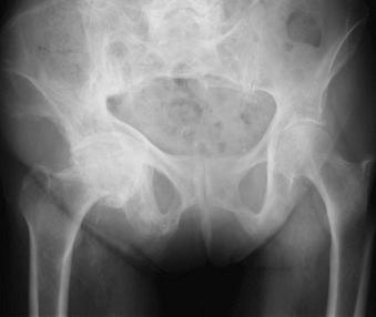 Fig. 80.1, Radiograph showing typical acetabular wear pattern seen in Paget disease.