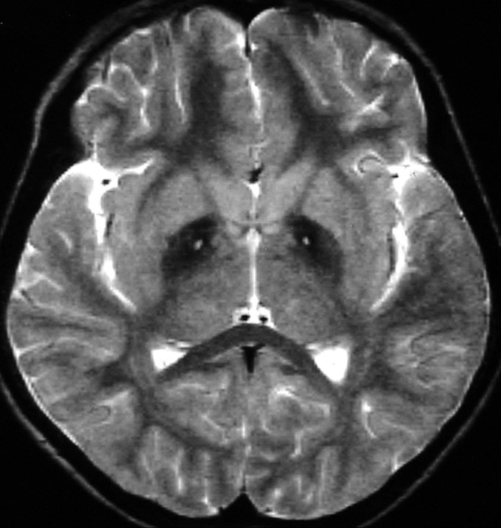 Figure 17.6, MRI findings in NBIA type 1 showing decreased T2-weighted and proton density signal in the globus pallidus—the “eye of the tiger” sign.