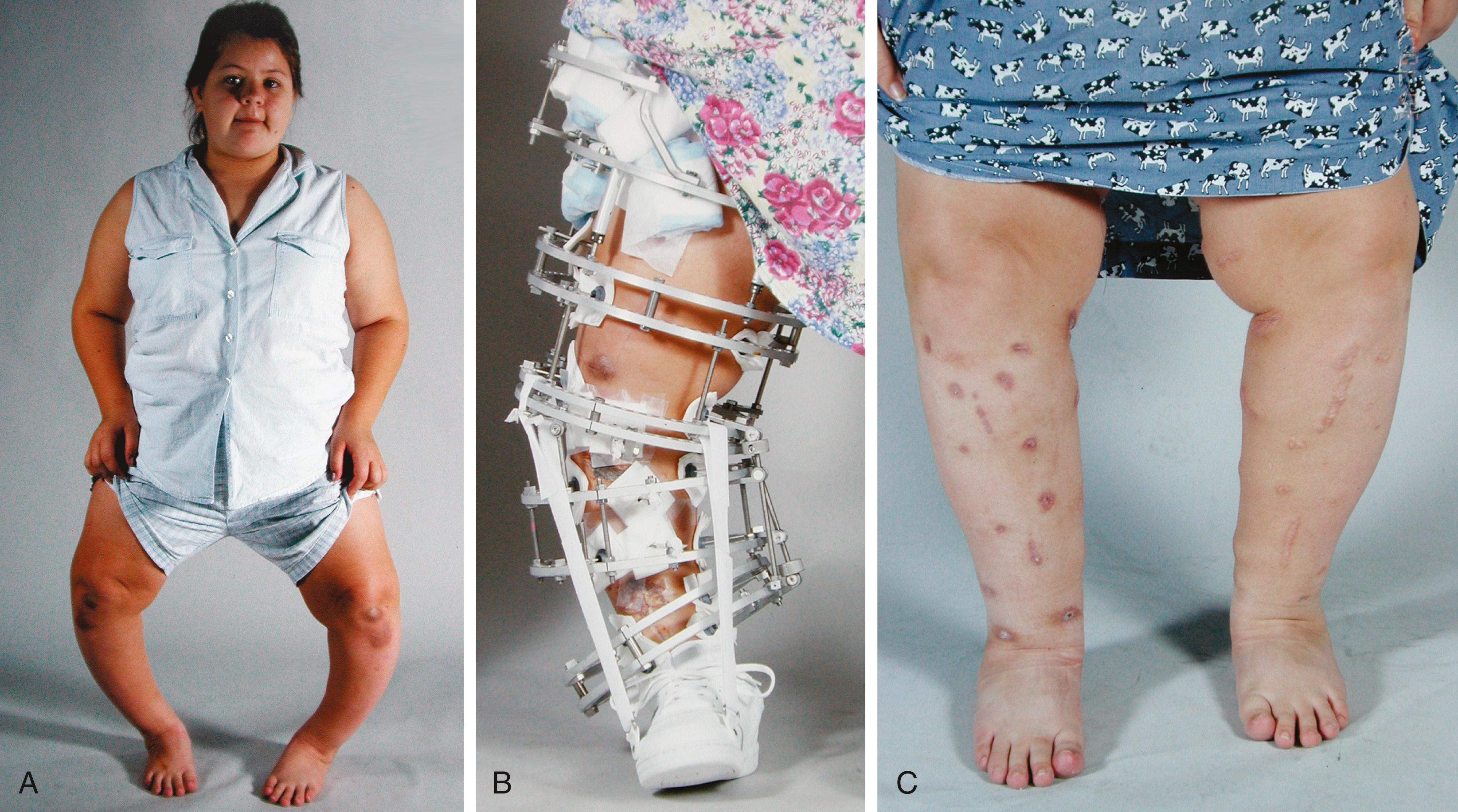 FIG. 38.11, (A) Clinical appearance of a 13-year-old girl with severe genu varum secondary to vitamin D–resistant rickets. Calluses on the knees were caused by crawling because of knee pain. (B) Treatment consisted of distal femoral, proximal tibial, and distal tibial corticotomies and gradual correction with the Ilizarov device. Surgery on the two legs was staged because of the extent of the frame. (C) Clinical appearance of the lower extremities at the end of treatment.