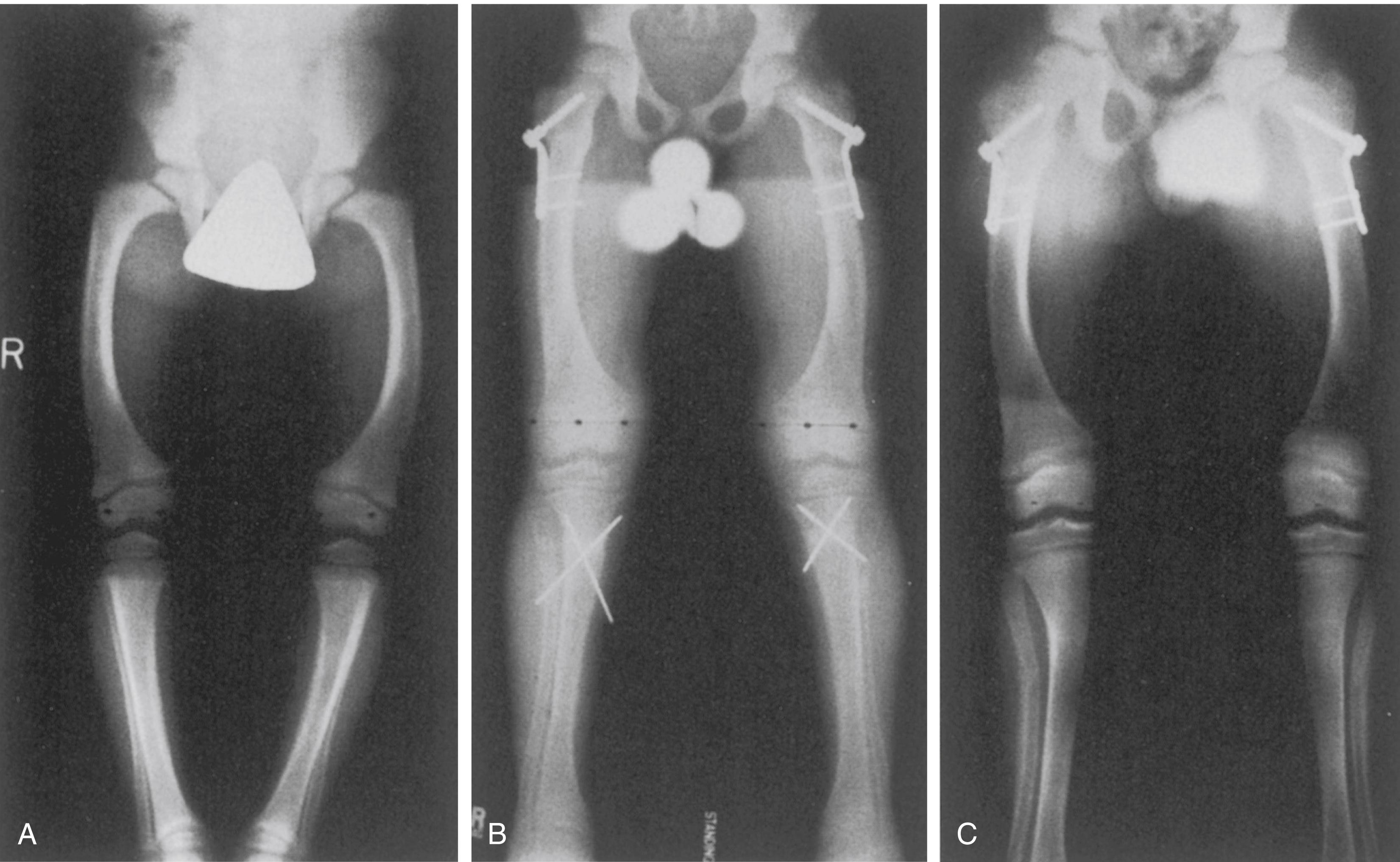 FIG. 38.12, (A) Coxa vara and genu varum in a 5-year-old boy with vitamin D–resistant rickets. (B) Postoperative radiograph obtained after corrective osteotomy with plate fixation of the proximal femora and osteotomy with K-wire fixation of the proximal tibiae. (C) Alignment remained satisfactory at 2-year follow-up.