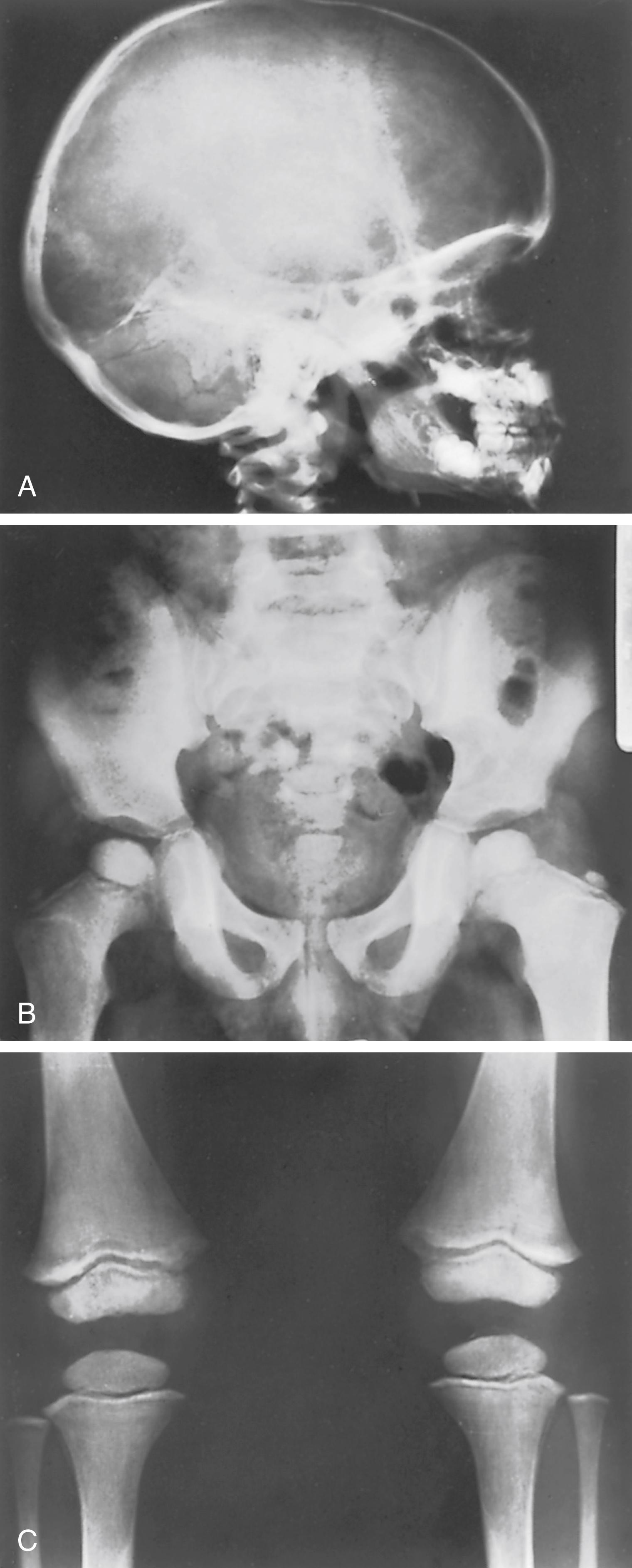 FIG. 38.13, Hypervitaminosis D in a 5-year-old boy who had taken 50,000 IU of vitamin D/day for the past 14 months. (A) Lateral view of the skull showing metastatic calcification of the cerebral and cerebellar falces. (B and C) Anteroposterior view of both hips and lower limbs. Note the increased radiopacity of the metaphyses.