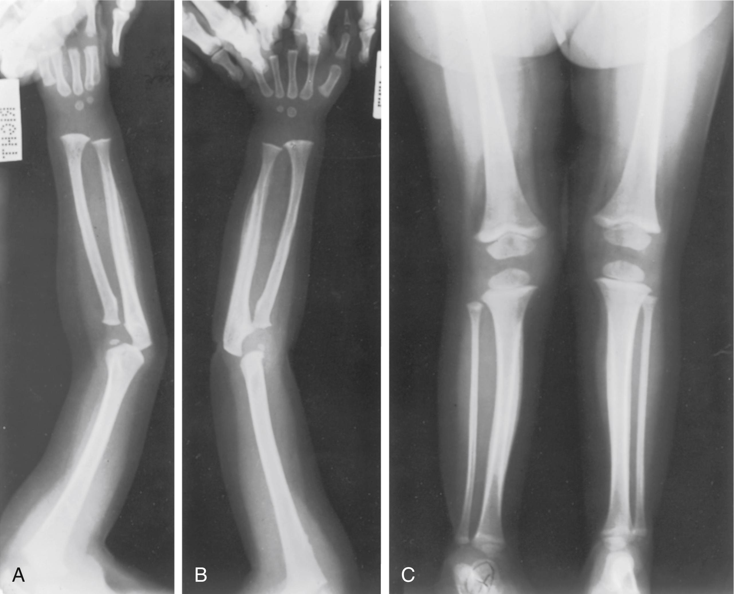 FIG. 38.14, Hypervitaminosis A in a 2-year-old child. Note the subperiosteal new bone formation and cortical thickening of both tibiae and both ulnae. The mandible and other facial bones are not affected. (A and B) Radiographs of the right and left forearms. (C) Radiograph of both lower limbs.