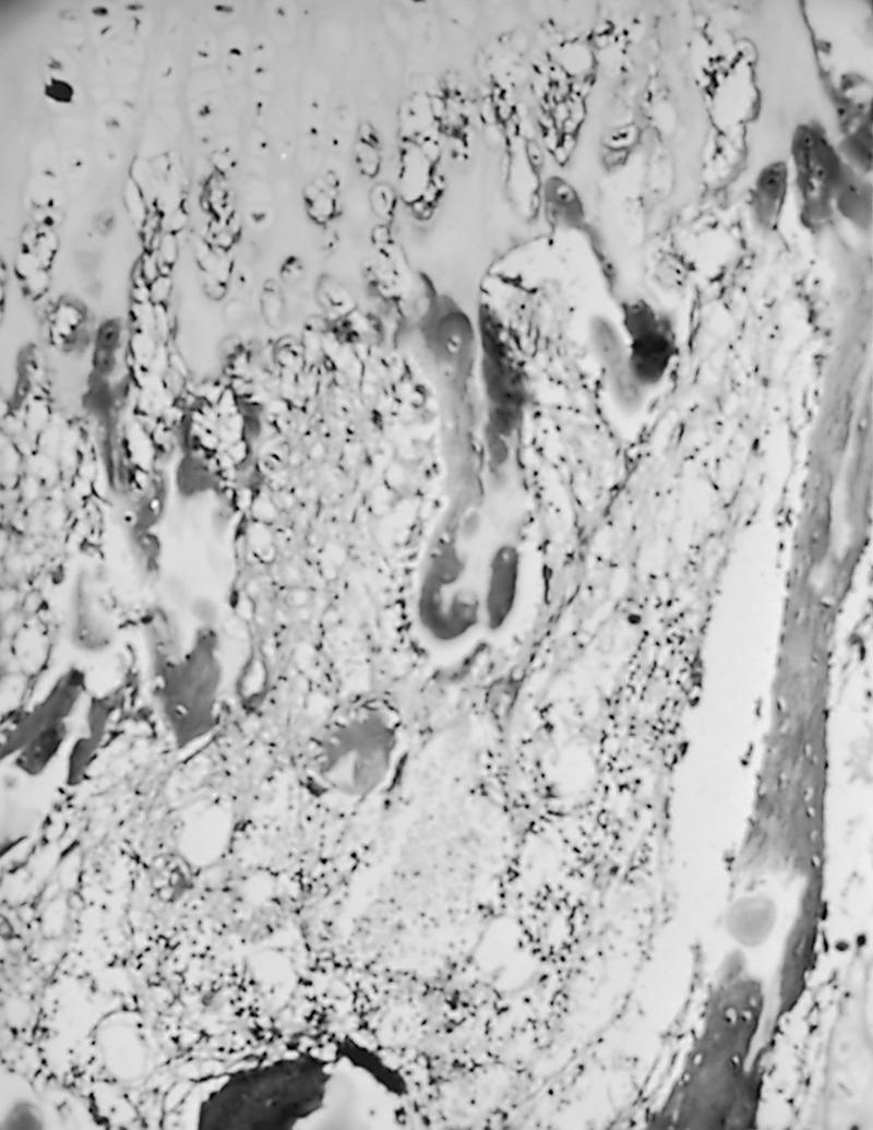 FIG. 38.2, Histologic appearance of rickets. A photomicrograph through the epiphyseal-metaphyseal junction shows uncalcified osteoid tissue, failure of deposition of calcium along the mature cartilage cell columns, and disorderly invasion of cartilage by blood vessels (×25, H & E).