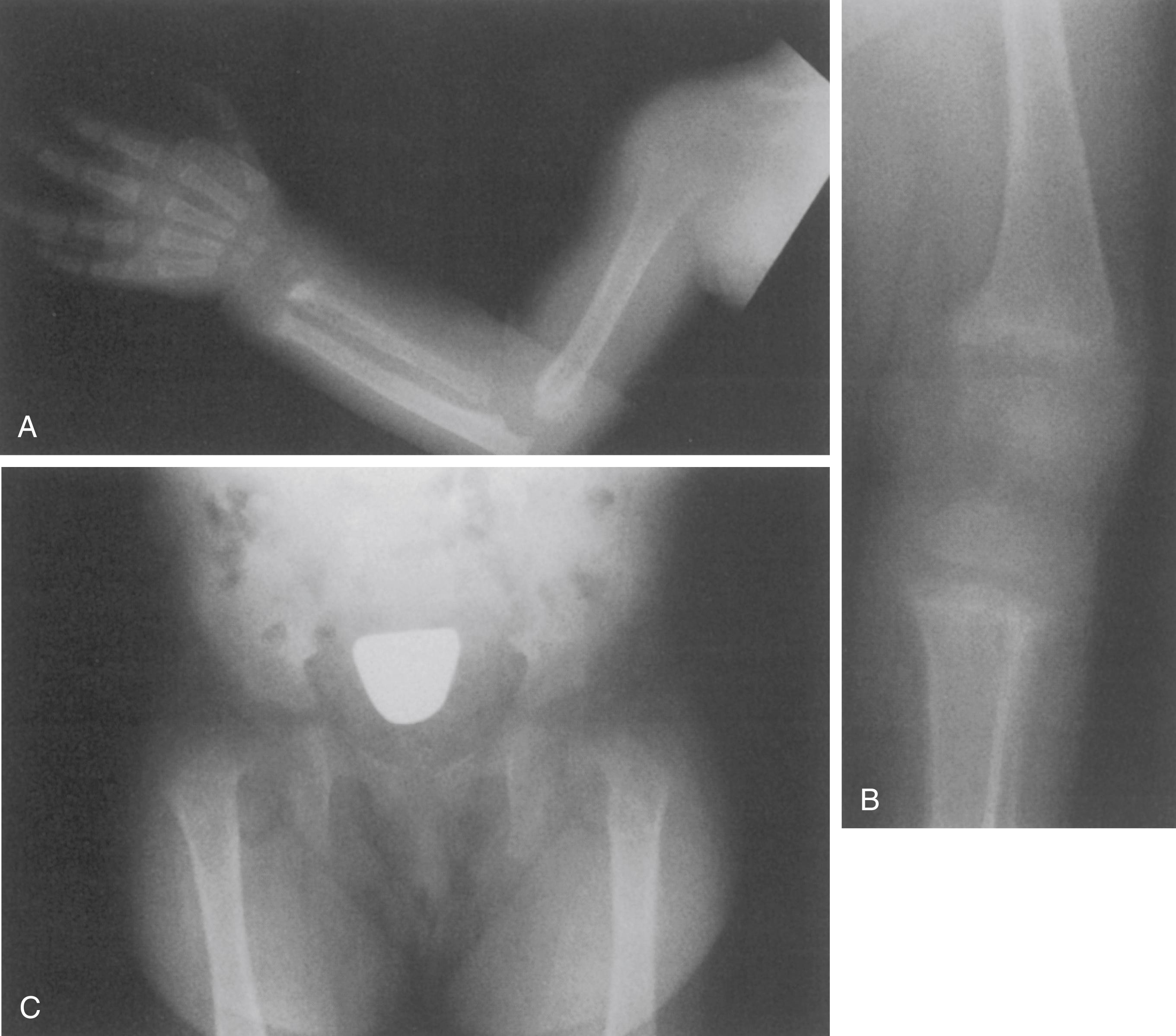 FIG. 38.3, Radiographs obtained in a 1-year-old black girl with nutritional rickets. (A) Forearm. (B) Knee. (C) Pelvis. All physes are widened and the metaphyses are indistinct. Cupping is most prominent in the metaphysis of the distal radius and ulna and at the knee. See also Fig. 38.6 .