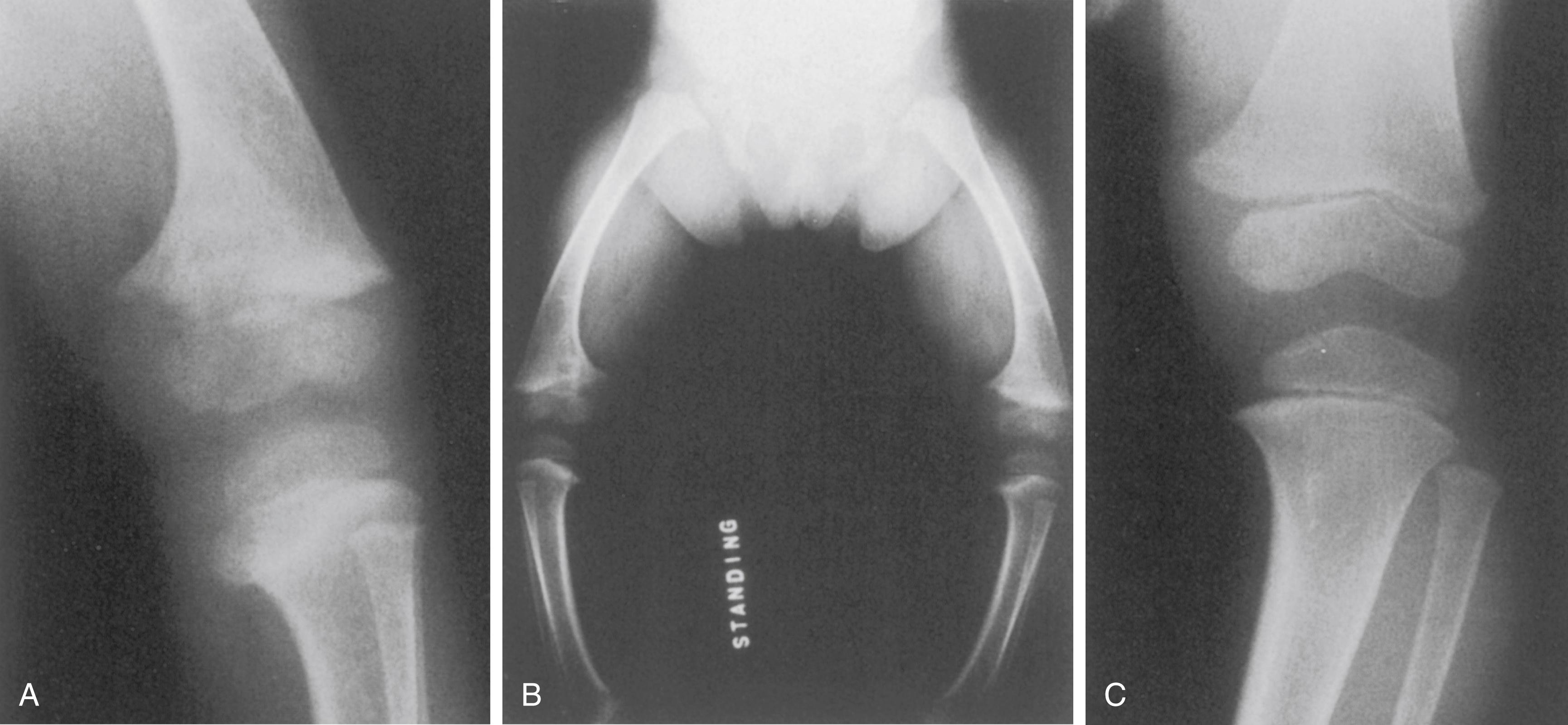 FIG. 38.4, (A) Hazy metaphysis with cupping in a young boy with rickets. (B) Accentuated genu varum is present. (C) With vitamin D replacement therapy, the bony lesions healed in 6 months.