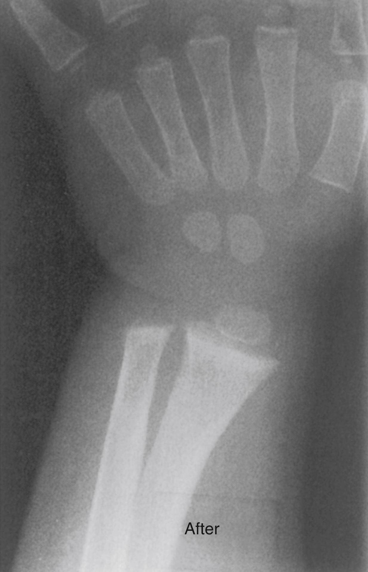 FIG. 38.5, Radiographic appearance of the wrist of the girl whose radiographs (rickets) appear in Fig. 38.3 after 4 months of treatment with vitamin D. The osteopenia has resolved and the physis is narrowed.