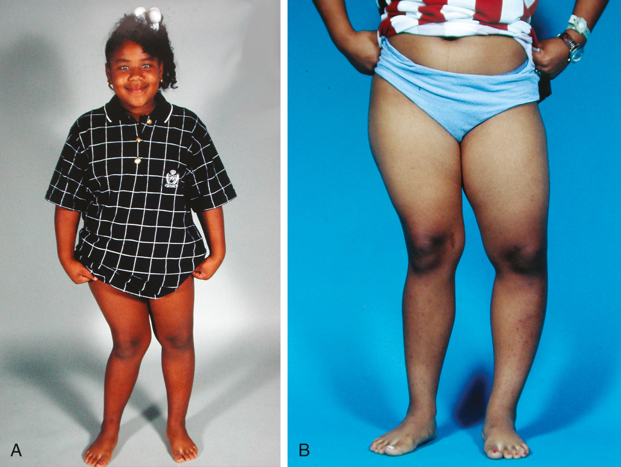 FIG. 38.6, (A) Unilateral genu varum in a 12-year-old child with poorly controlled vitamin D–resistant rickets. (B) Same child at 15 years of age after right medial hemiepiphysiodesis of the femur. Left genu varum is now apparent.