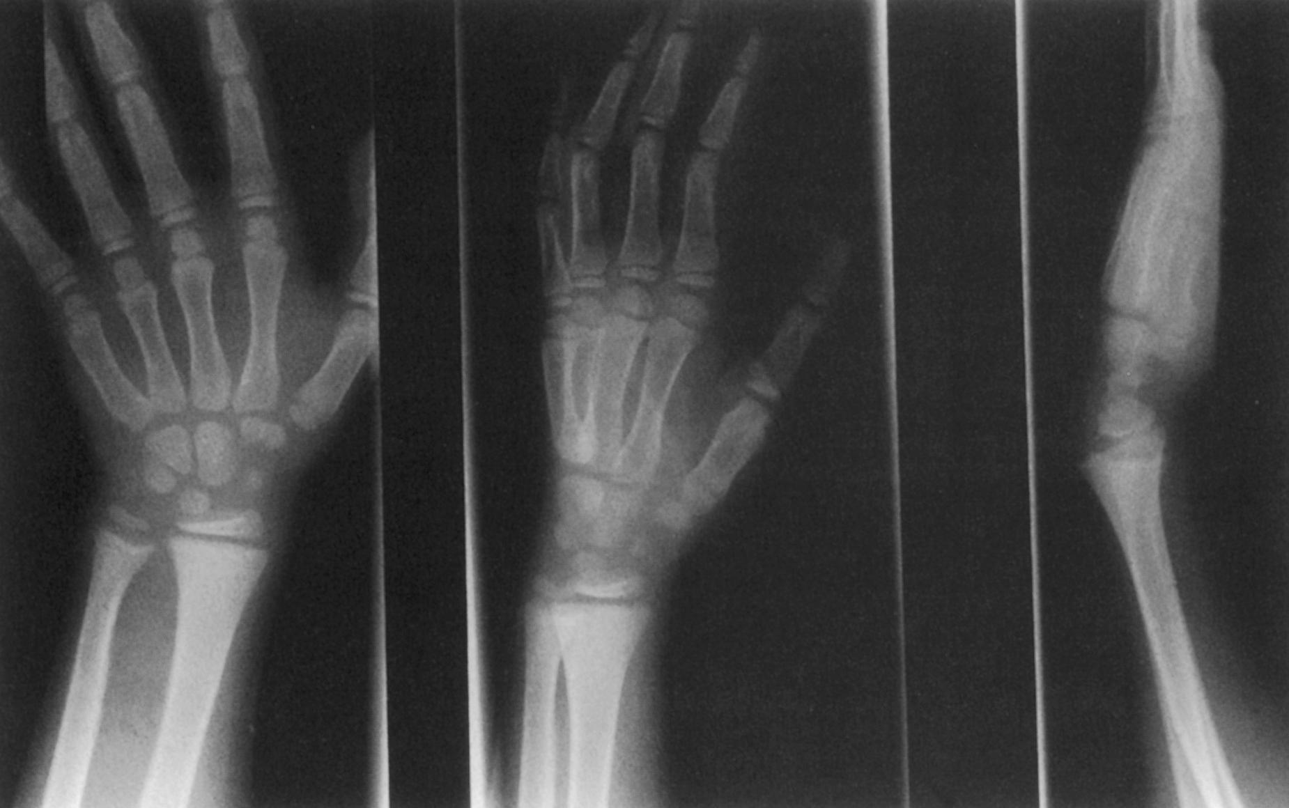 FIG. 38.8, Physeal widening and metaphyseal cupping of the distal end of the radius and ulna in a 7-year-old child (same as in Fig. 38.7 ) with vitamin D–resistant rickets.