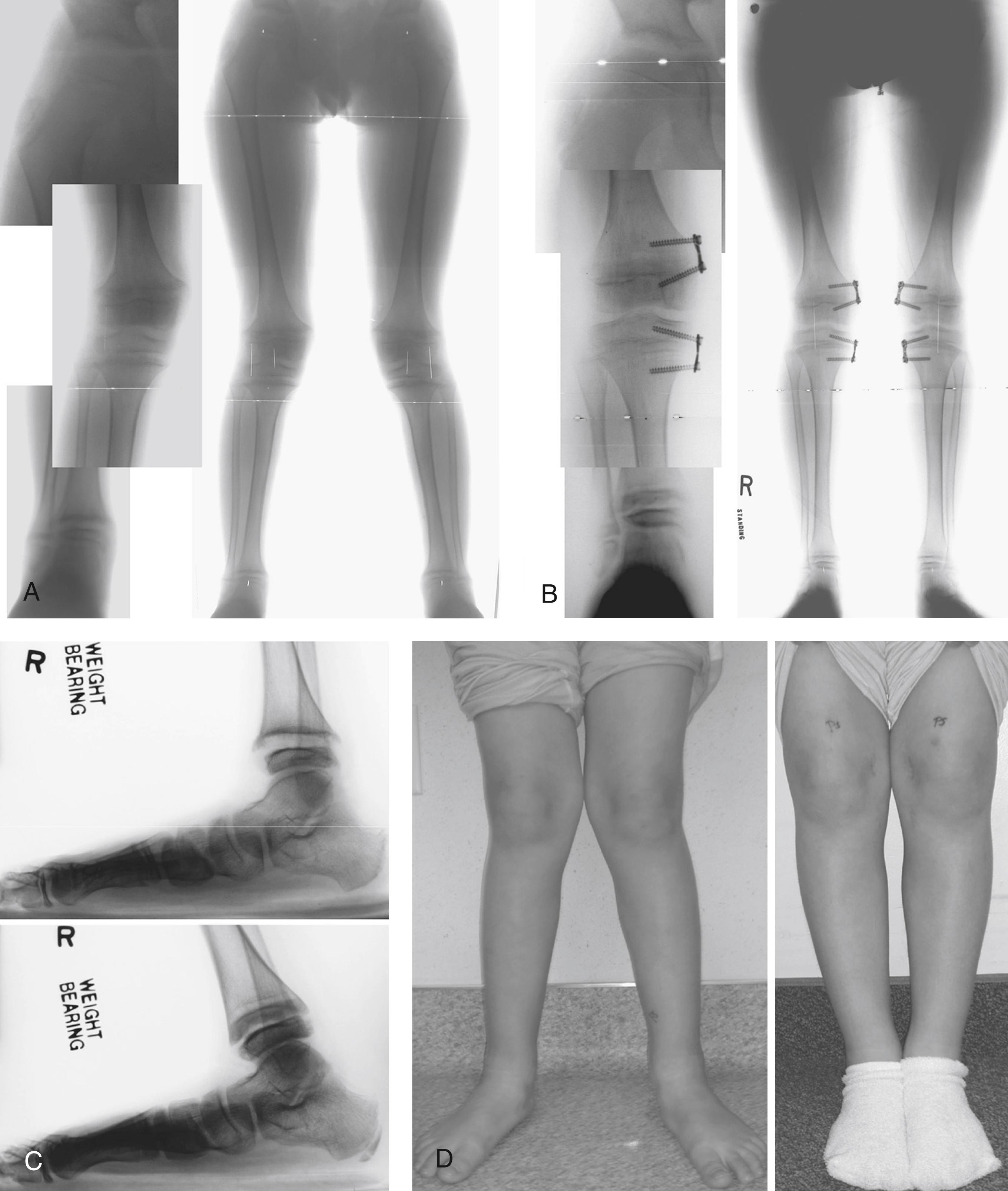 FIG. 38.9, (A) This 6-year old boy with hypophosphatemic rickets presented with a circumduction gait and knee pain. He was on appropriate medical management. Note the classic widening and cupping of the physes. (B) Nine months after stapling, mechanical axes are neutral, and the circumduction gait and pain have resolved. Note the qualitative improvement in the physes at the hip, knee, and ankle. The plates were removed. (C) With neutralization of the mechanical axis and resolution of circumduction gait during a 9-month interval and despite no change in medications, note the “healing” that has occurred within the distal tibial physis. (D) Clinical appearance before and 9 months after guided growth. It is not difficult to imagine how improved gait mechanics and alignment would benefit the “sick physes,” not only at the knee but at the hip and ankle as well.