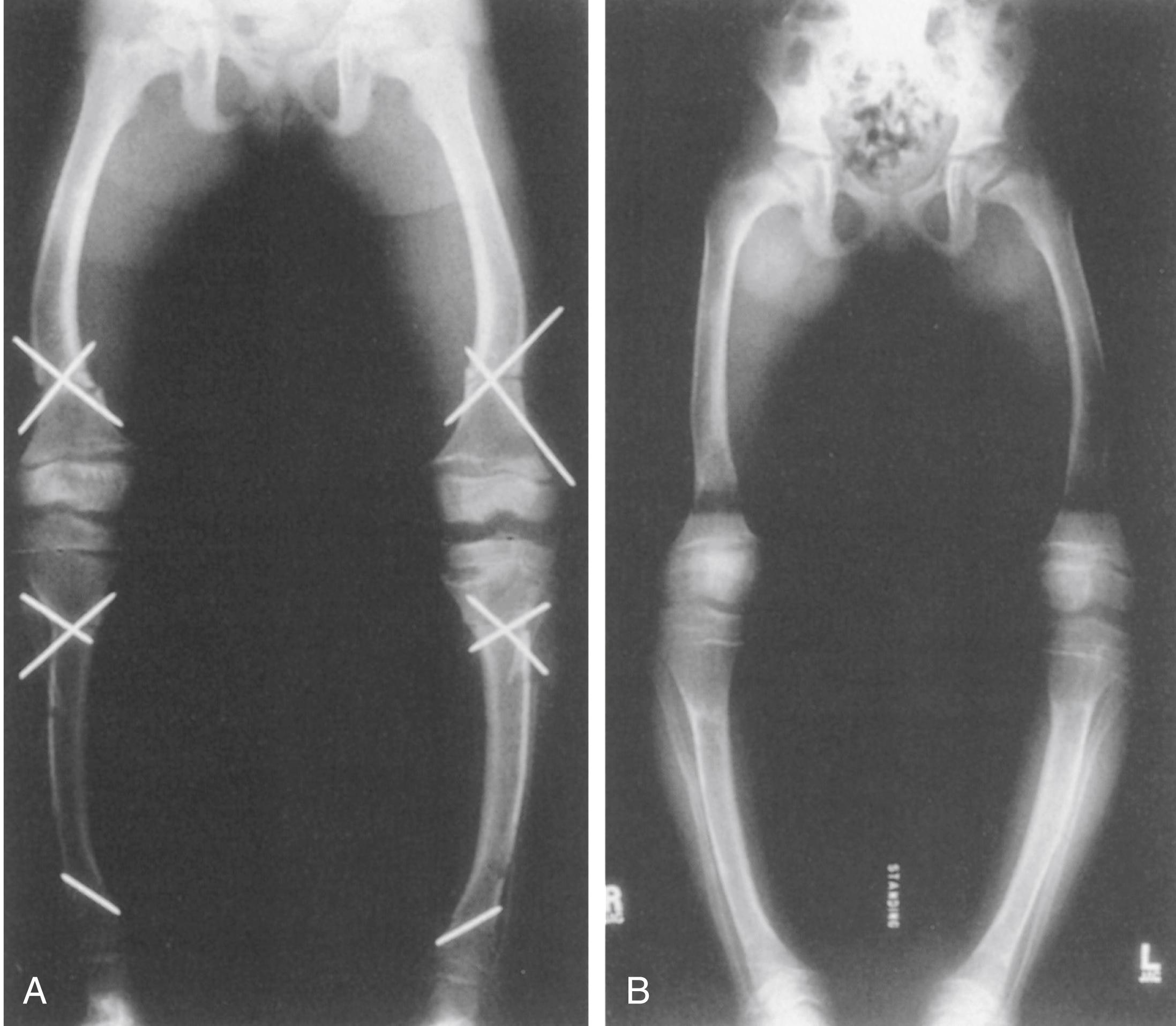 FIG. 38.10, Postoperative radiographs of the child whose imaging findings are shown in Figs. 38.7 and 38.8 . (A) Appearance after distal femoral, proximal tibial, and distal tibial osteotomies for treatment of genu varum. (B) Varus is recurring 1 year after surgery.