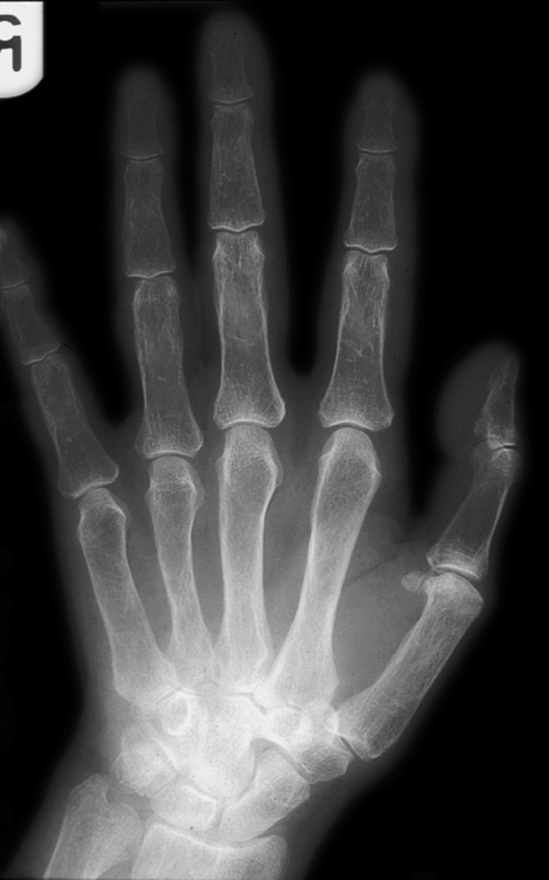 Osteoporosis. Reduced bone density, thinned cortex and reduced number of trabeculae, those which remain appearing more prominent. *