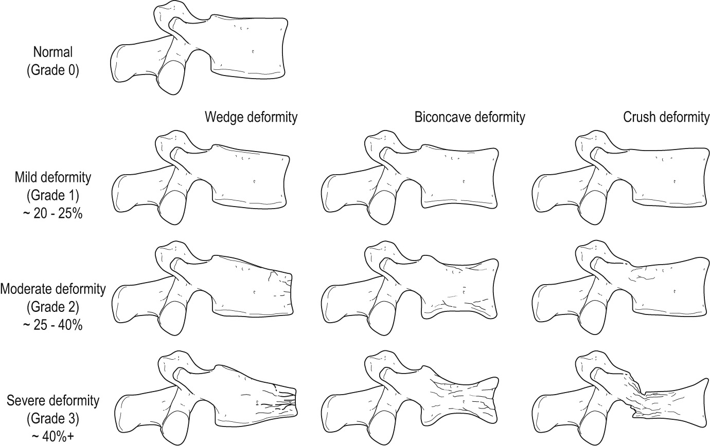 Osteoporosis – grading vertebral fractures. Vertebral fractures are strong predictors of future fractures (×5 for vertebral fracture and ×2 for hip fractures) so it is important that they are accurately and clearly reported by radiologists. The higher the grade of vertebral fracture, the higher the risk of future fracture. *