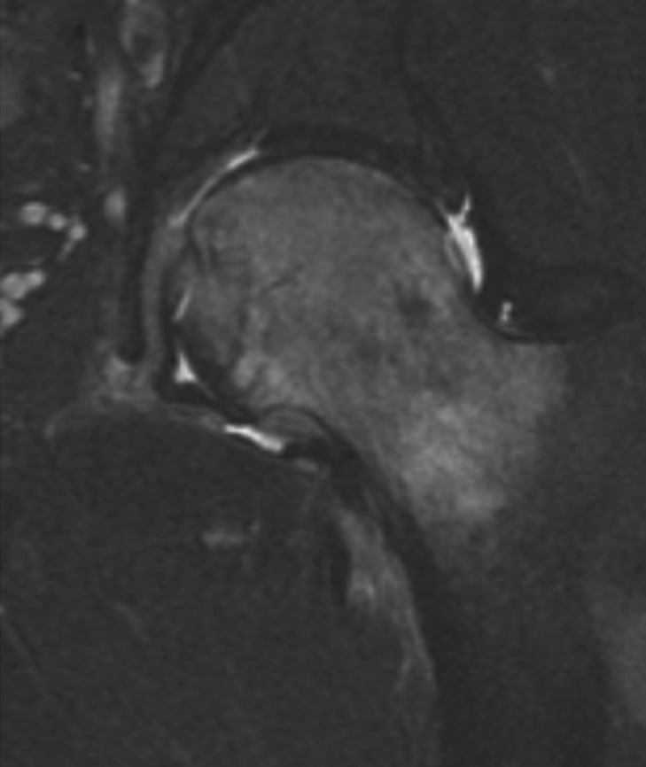 Transient osteoporosis of the hip. STIR image of the left hip in a 42-year-old man with transient osteoporosis. Note homogeneous bone marrow oedema pattern without focal linear signal abnormalities, which would suggest a fracture, or deformities as might occur in avascular necrosis of the femoral head with subchondral fracture. **