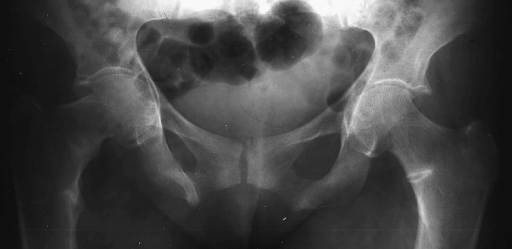 Osteomalacia. The pathognomonic XR feature is the Looser's zone – radiolucent, unmineralized linear areas perpendicular to the cortex and which may have a sclerotic margin (demonstrated in the medial aspect of the left femoral neck). *