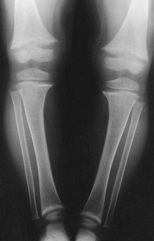 Rickets. There is splaying of all the visible metaphyses, with widened epiphyseal plates. In addition there is bowing of the femora and bones of the lower leg. †