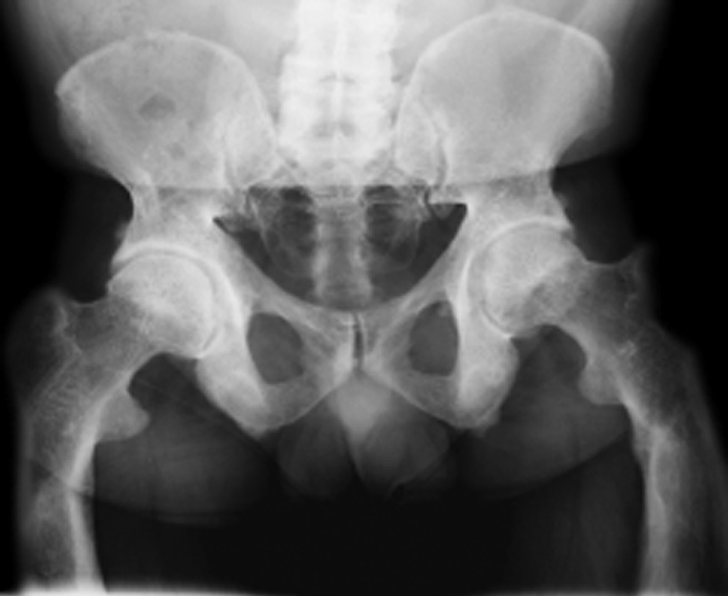Patent sacroiliac joints, dense bones, and bowed femora in X-linked hypophosphatemic osteomalacia. ©35