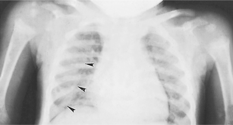 Rickety rosary. Widening of the anterior ribs is demonstrated (arrows). Metaphyseal changes are also seen in the proximal humeri. †