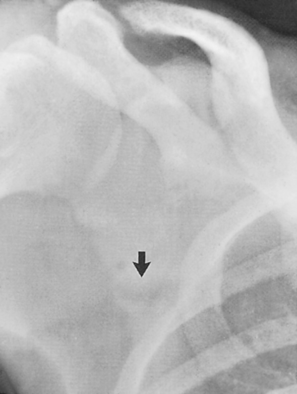 Looser's zone. There is lucency with surrounding sclerosis in the lateral border of the scapula. †