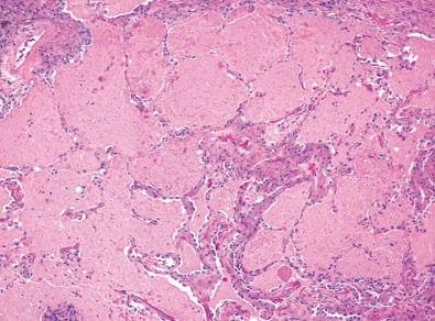 Fig. 38.1, Pulmonary alveolar proteinosis. Histologic specimen shows filling of the alveolar airspaces with a granular eosinophilic proteinaceous material .