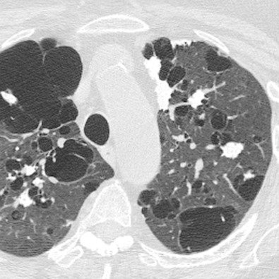 Fig. 38.11, Nodular parenchymal amyloidosis with lymphoid interstitial pneumonia in a patient with Sjögren syndrome. Axial CT shows calcified nodules and cysts throughout both lungs. Pulmonary cysts associated with amyloidosis are most commonly seen in patients with Sjögren syndrome and may be secondary to coexistent lymphoid interstitial pneumonia or amyloidosis itself.