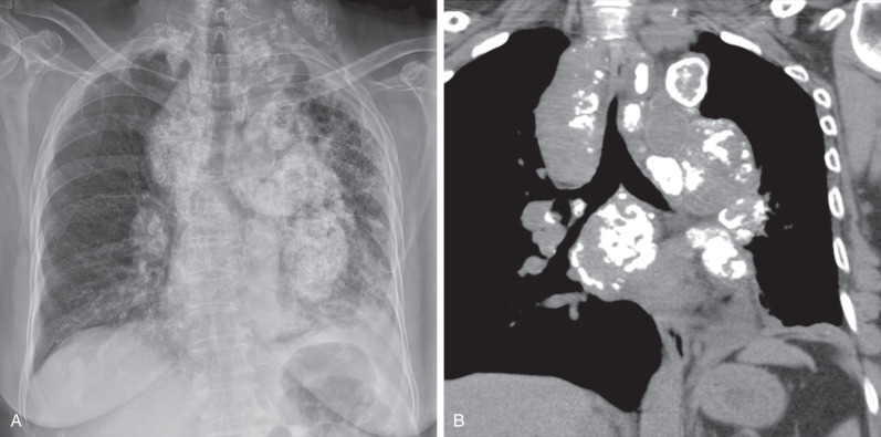 Fig. 38.12, Calcified lymph nodes with lung fibrosis from systemic (light-chain) AL amyloidosis associated with monoclonal gammopathy of undetermined significance. (A) Posteroanterior chest radiograph shows enlarged mediastinal and left neck calcified lymph nodes. Note left lung volume loss with fibrosis secondary to long-standing left pulmonary artery and left main bronchus compression. (B) Coronal noncontrast CT shows massive partially calcified mediastinal and hilar lymphadenopathy, which causes occlusion of the distal left main bronchus.