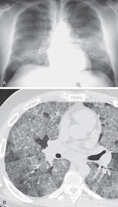 Fig. 38.2, Pulmonary alveolar proteinosis: imaging findings. (A) Posteroanterior chest radiograph shows airspace consolidation and ground-glass opacities mainly in the perihilar regions (butterfly pattern) with sparing of the peripheral regions. Note vaguely nodular appearance. (B) High-resolution CT demonstrates extensive bilateral ground-glass opacities and a superimposed fine linear pattern forming polygonal arcades (“crazy paving” pattern). Note sharp demarcation of normal lung from abnormal lung.