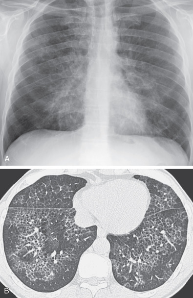 Fig. 38.3, Pulmonary alveolar proteinosis: imaging findings. (A) Posteroanterior chest radiograph shows asymmetric hazy areas of increased opacity (ground-glass opacities) and faint reticulonodular pattern in the right middle and bilateral lower lung zones. (B) High-resolution CT shows bilateral ground-glass opacities and superimposed fine linear pattern forming polygonal arcades (“crazy paving” pattern). Note the sharp demarcation between normal and abnormal parenchyma, a feature that usually reflects lobular boundaries. Also note the presence of mild emphysema.