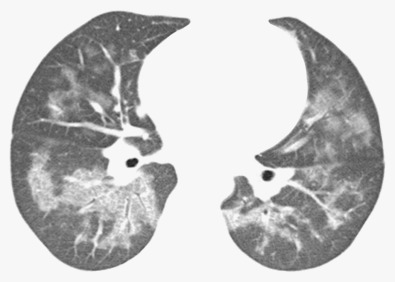 Fig. 38.4, Secondary pulmonary alveolar proteinosis in an 11-year-old girl undergoing immunosuppressive therapy for aplastic anemia. High-resolution CT shows bilateral ground-glass opacities with sparing of the peripheral lung. Mild superimposed linear opacities (“crazy paving” pattern) are present in the lower lobes.