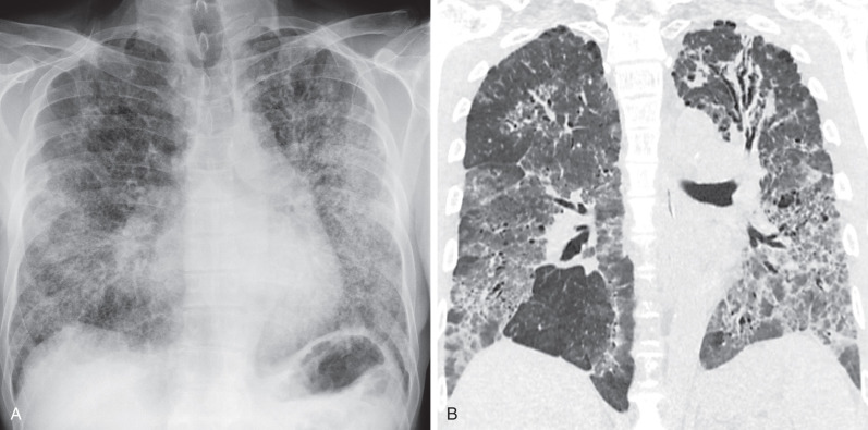 Fig. 38.5, Pulmonary alveolar proteinosis with fibrosis. (A) Posteroanterior chest radiograph shows patchy bilateral opacities with reticulation. (B) Coronal CT shows asymmetric ground-glass opacities with interlobular septal thickening and intralobular lines (“crazy paving” pattern). Note traction bronchiectasis and traction bronchiolectasis, as well as bilateral major fissure distortion indicating a component of lung fibrosis. As is typically seen, there are several areas of lung that are relatively spared, best visualized in the right lower lobe.