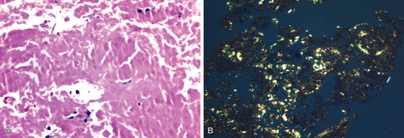 Fig. 38.6, Amyloidosis. (A) Histologic specimen shows extracellular amorphous eosinophilic material. (B) Specimen stained with Congo red and examined with polarizing microscopy shows characteristic apple-green birefringence.