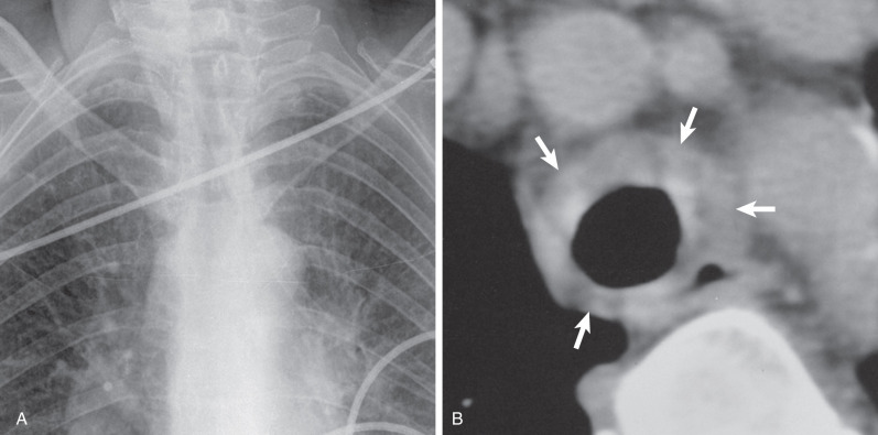 Fig. 38.7, Diffuse tracheal amyloidosis. (A) Magnified view from a chest radiograph shows narrowing of the mid trachea. (B) Axial CT from a different patient immediately above the level of the aortic arch shows marked circumferential thickening of the trachea (arrows) . On CT and at bronchoscopy, the entire trachea was abnormal.