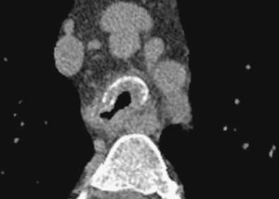 Fig. 38.8, Diffuse tracheobronchial amyloidosis. Magnified view of the trachea shows circumferential thickening and foci of calcification.