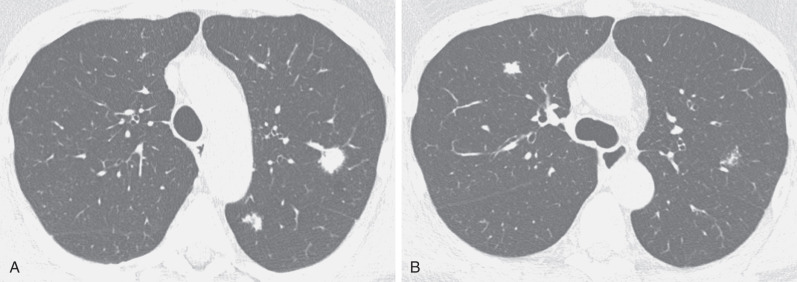 Fig. 38.9, Nodular parenchymal amyloidosis proven at surgical resection. High-resolution CT images at the level of the aortic arch (A) and tracheal carina (B) show bilateral nodules with spiculated margins.
