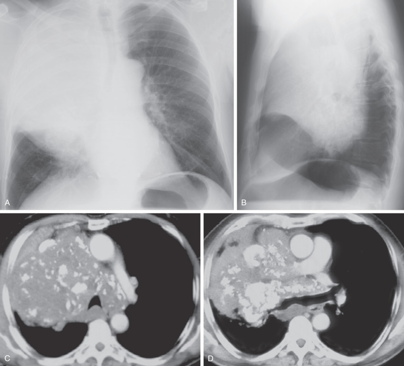 Fig. 38.10, Nodular parenchymal amyloidosis. Posteroanterior (A) and lateral (B) chest radiographs show a homogeneous mass occupying most of the right hemithorax. CT at the level of the lower trachea (C) and left main bronchi (D) show a large right upper and middle lobe mass with numerous coarse foci of calcification. The mass extends into the mediastinum, is associated with calcified mediastinal lymph nodes, and compresses the trachea and right bronchi.