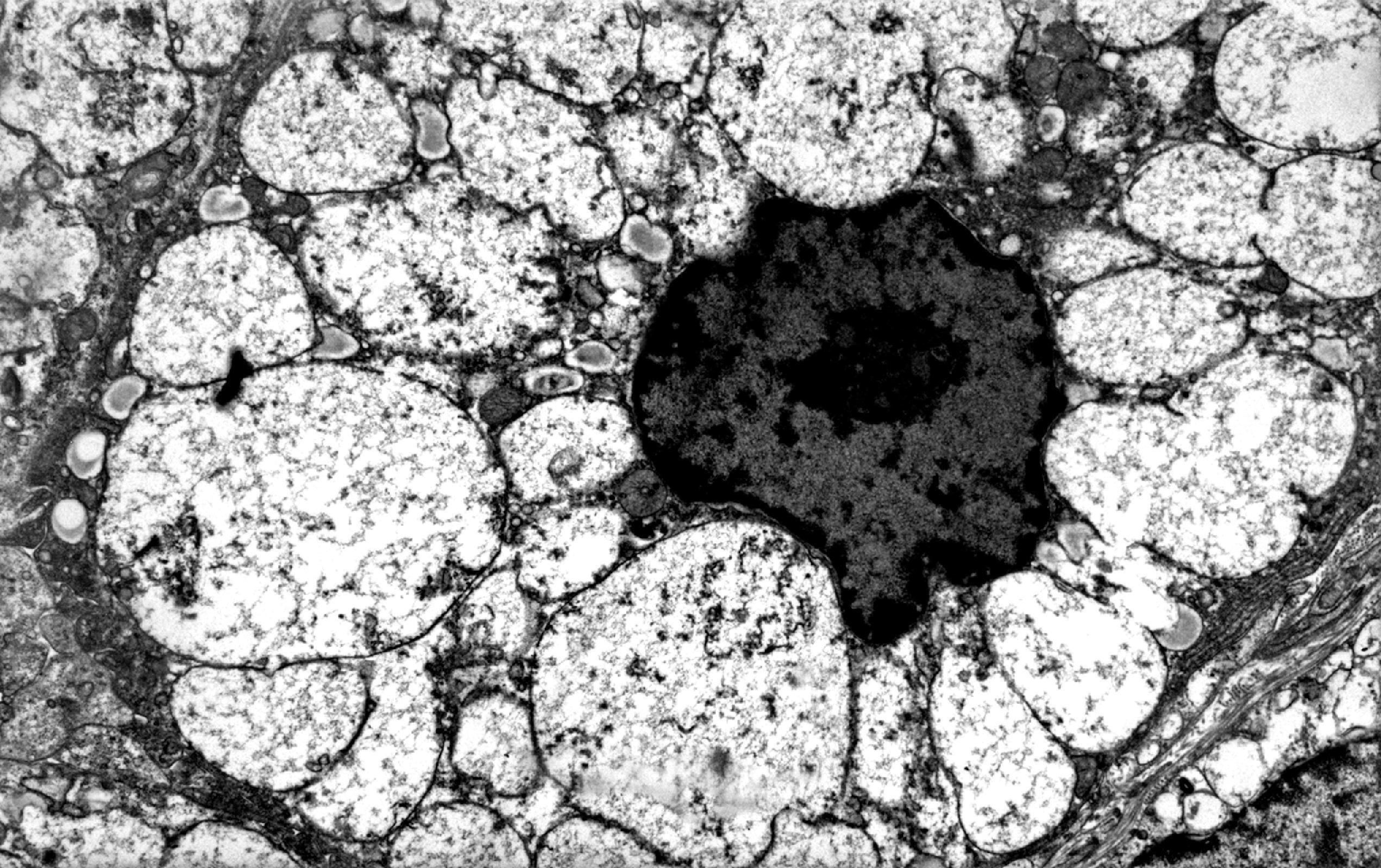 FIGure 8.1, Vacuoles in fibroblasts in I-cell disease.