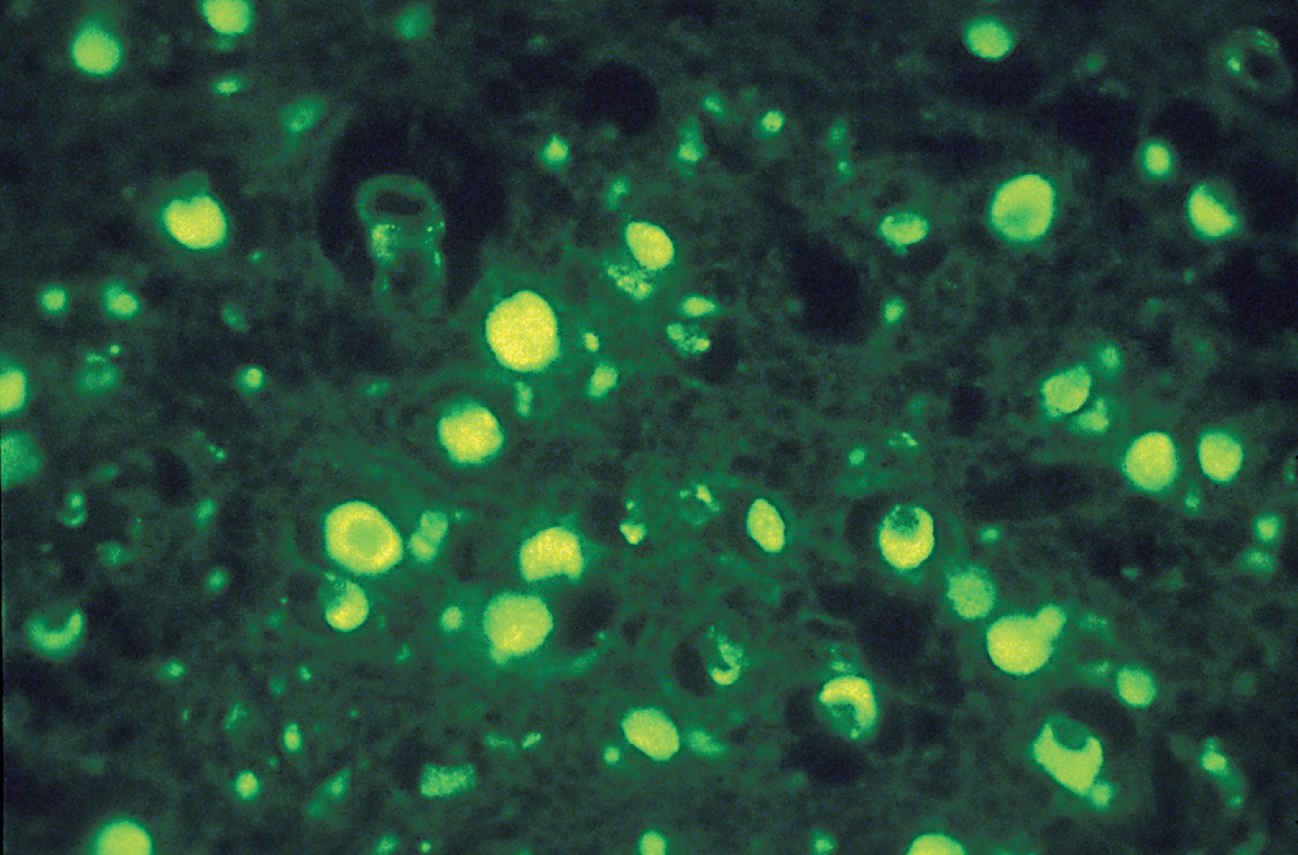 FIGure 8.13, Autofluorescent products in neuronal ceroid lipofuscinosis.