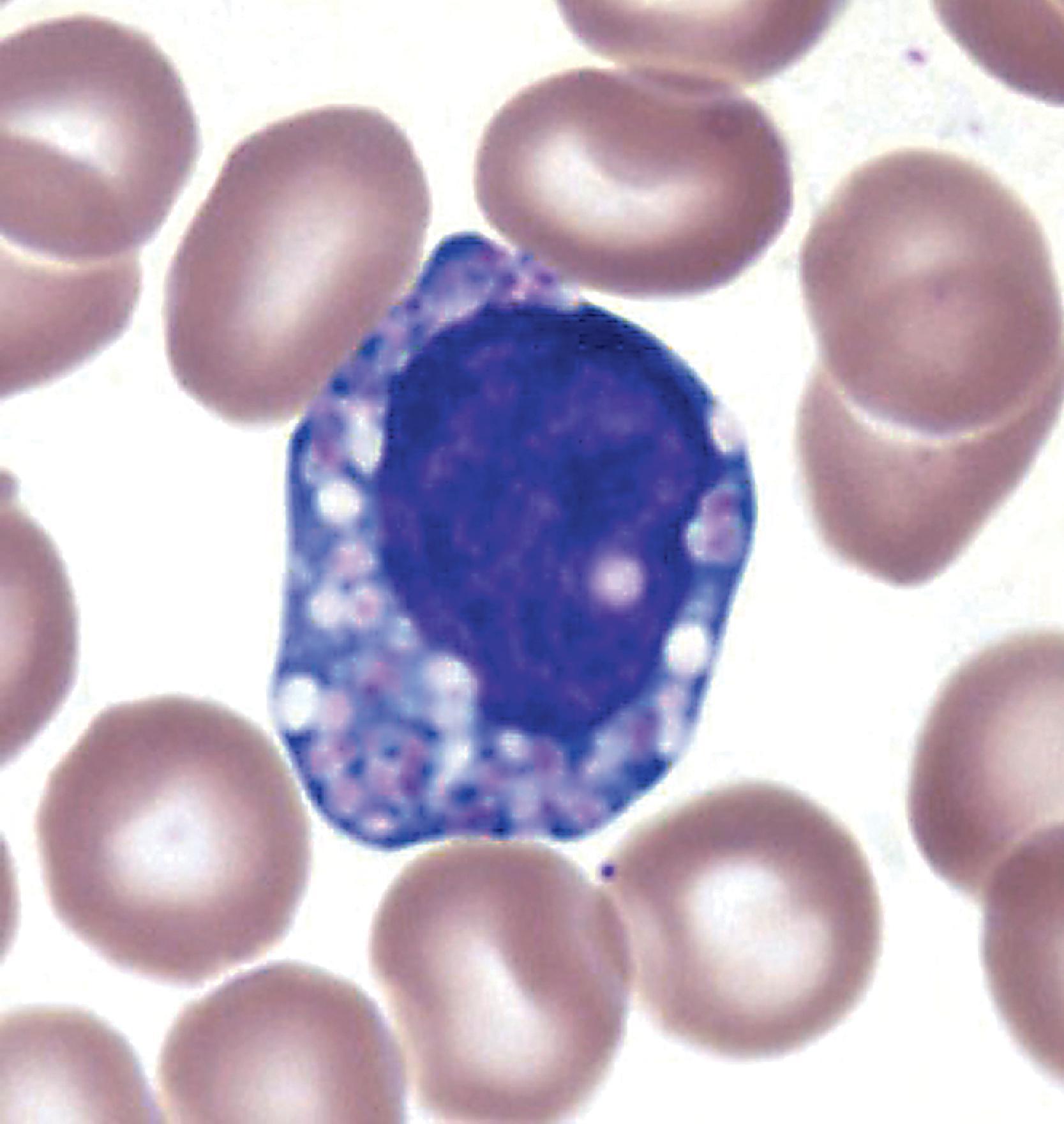 FIGure 8.14, Vacuolization of circulating monocyte in I-cell disease.