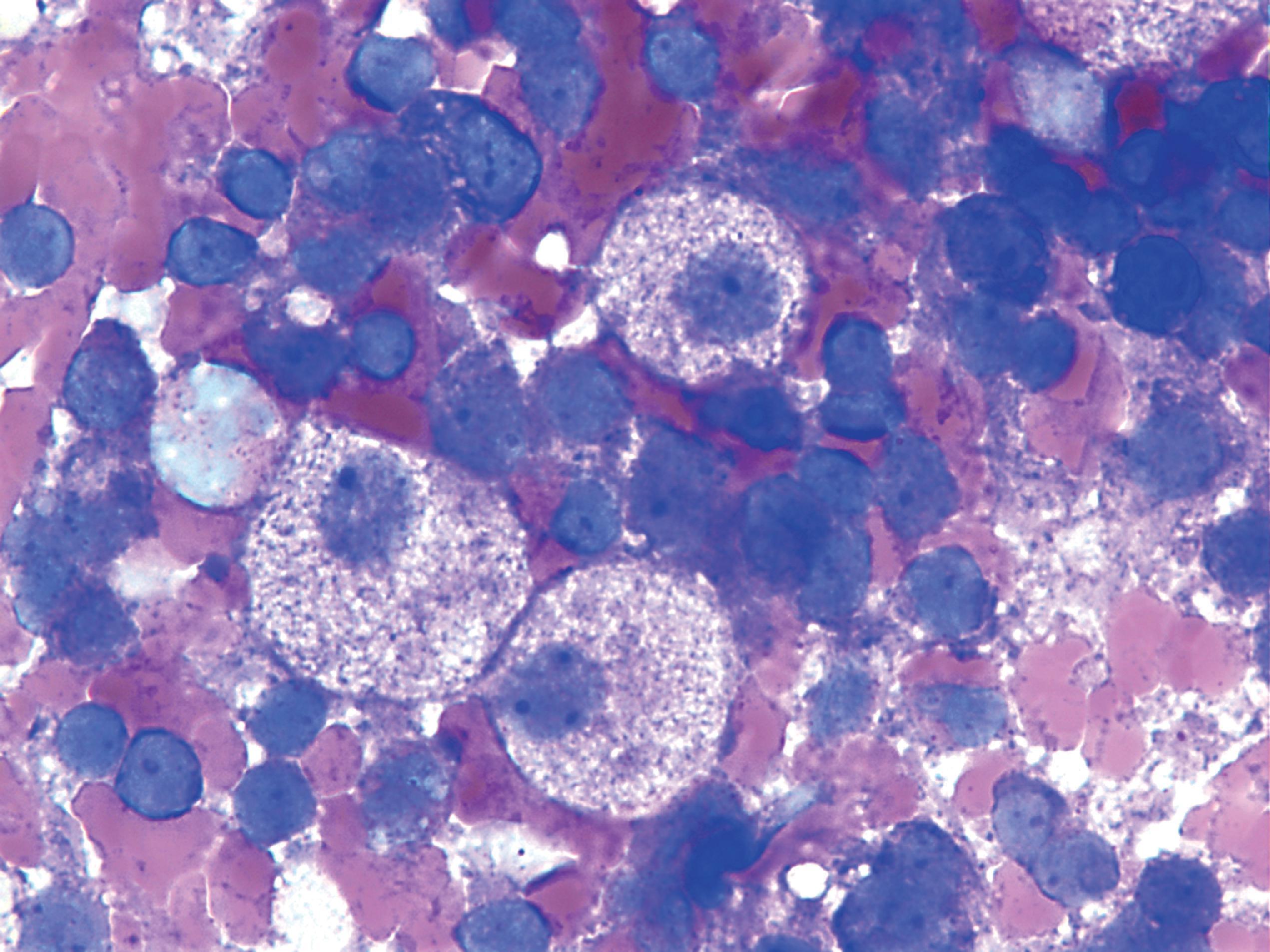 FIGure 8.16, Niemann-Pick cells in the bone marrow.