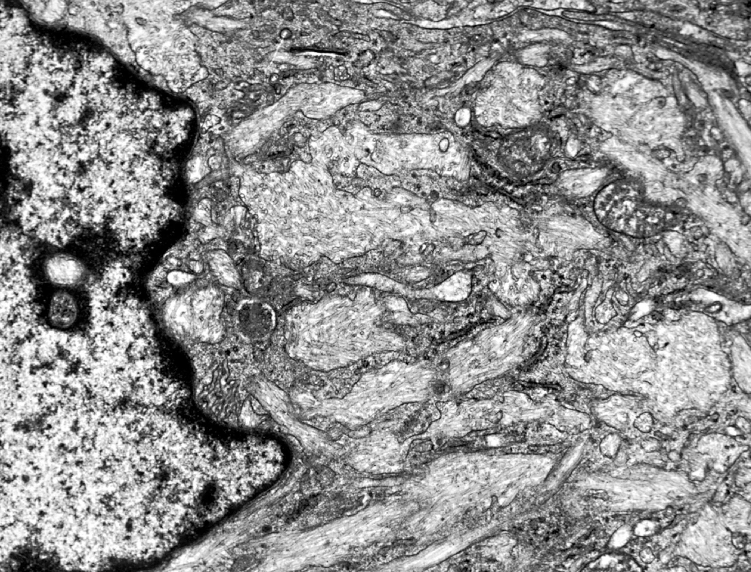 FIGure 8.18, Tubular lysosomal inclusions in Gaucher disease.