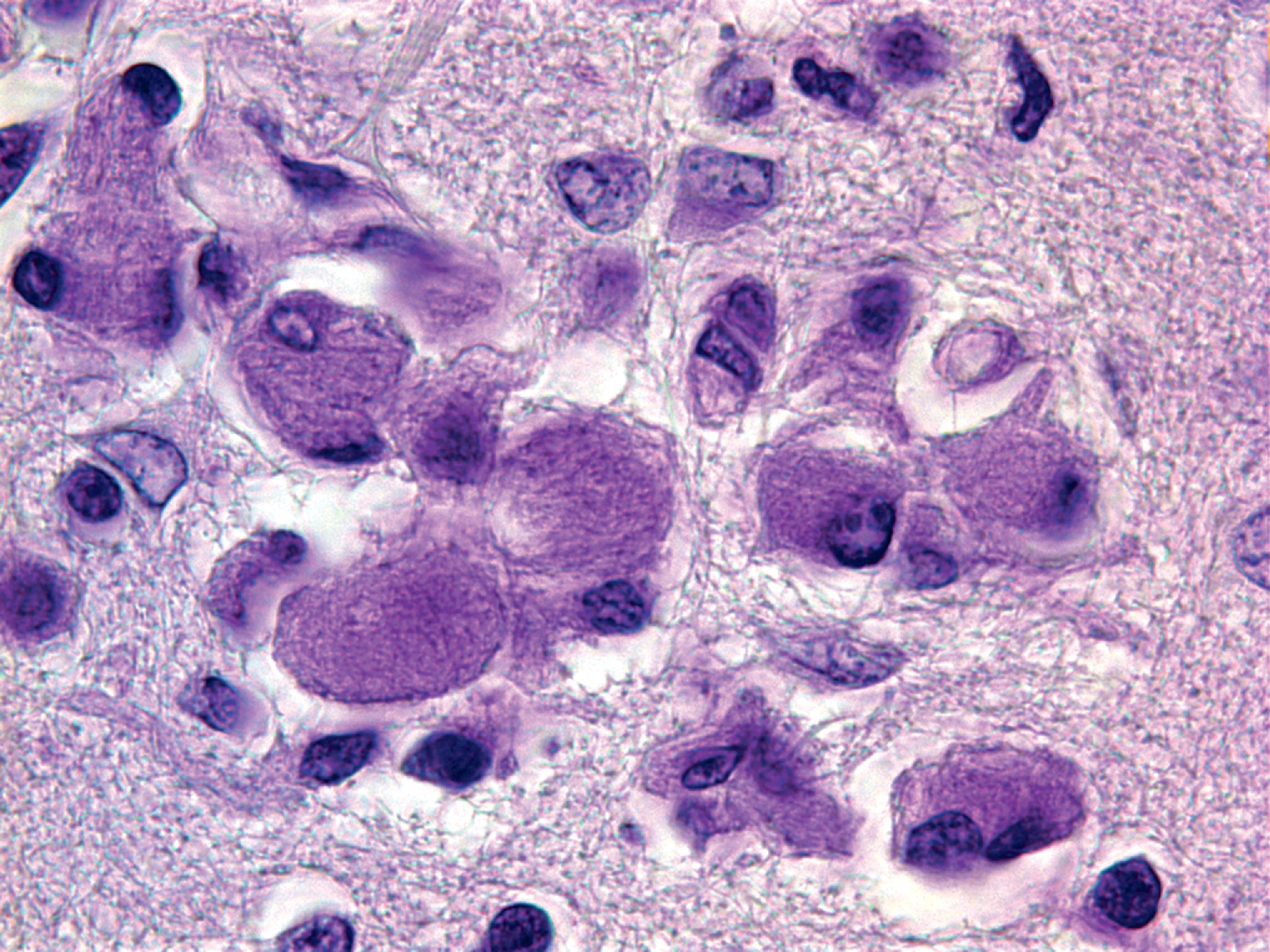 FIGure 8.19, Gaucher cells in the brain in type 2 Gaucher disease.