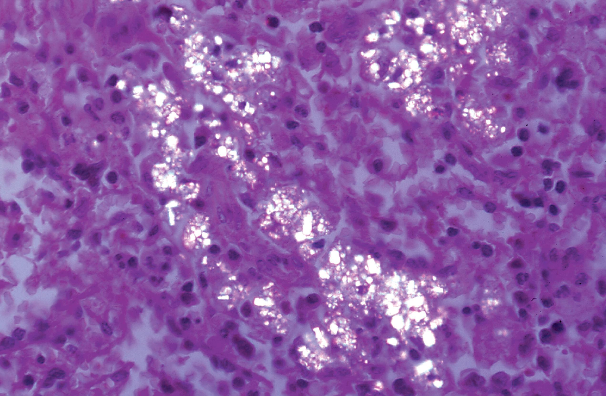 FIGure 8.2, Cystinosis. Birefringent cystine crystals in the kidney.