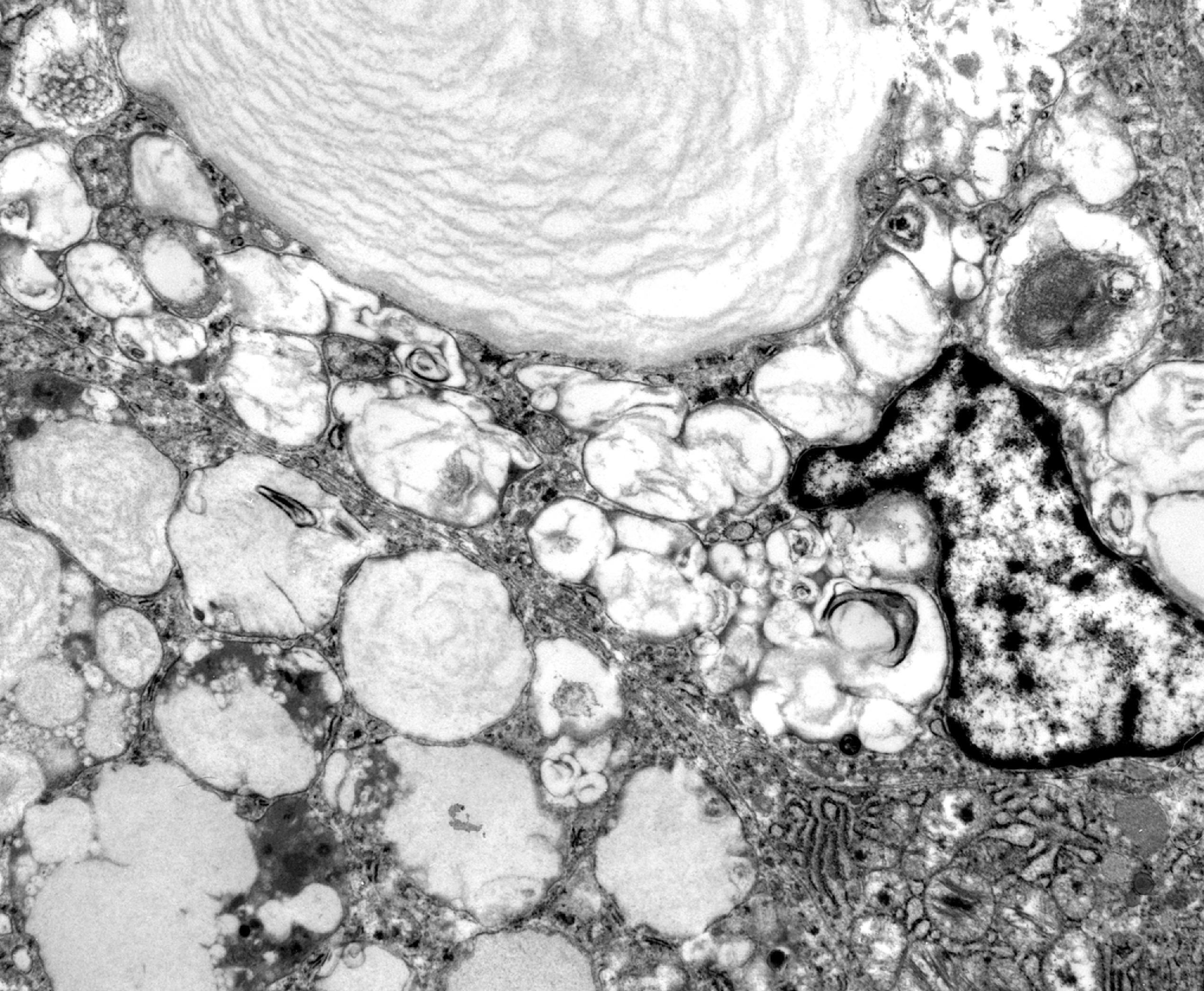 FIGure 8.21, Lamellar structures in Fabry disease.