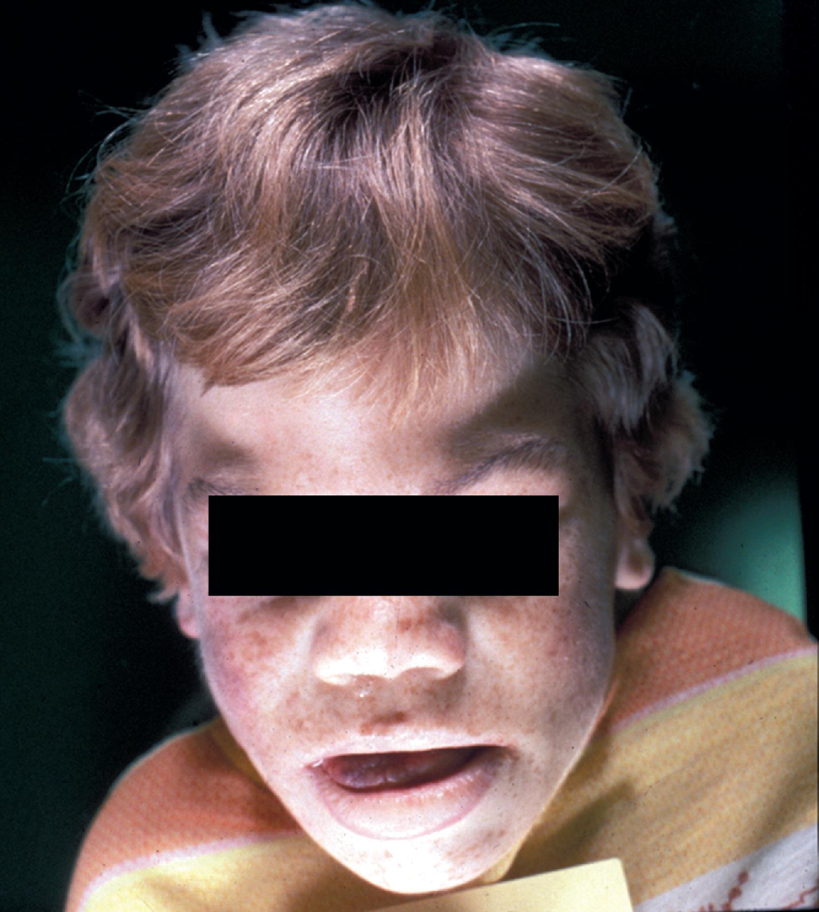 FIGure 8.23, Coarse facial features in mucopolysaccharidosis.