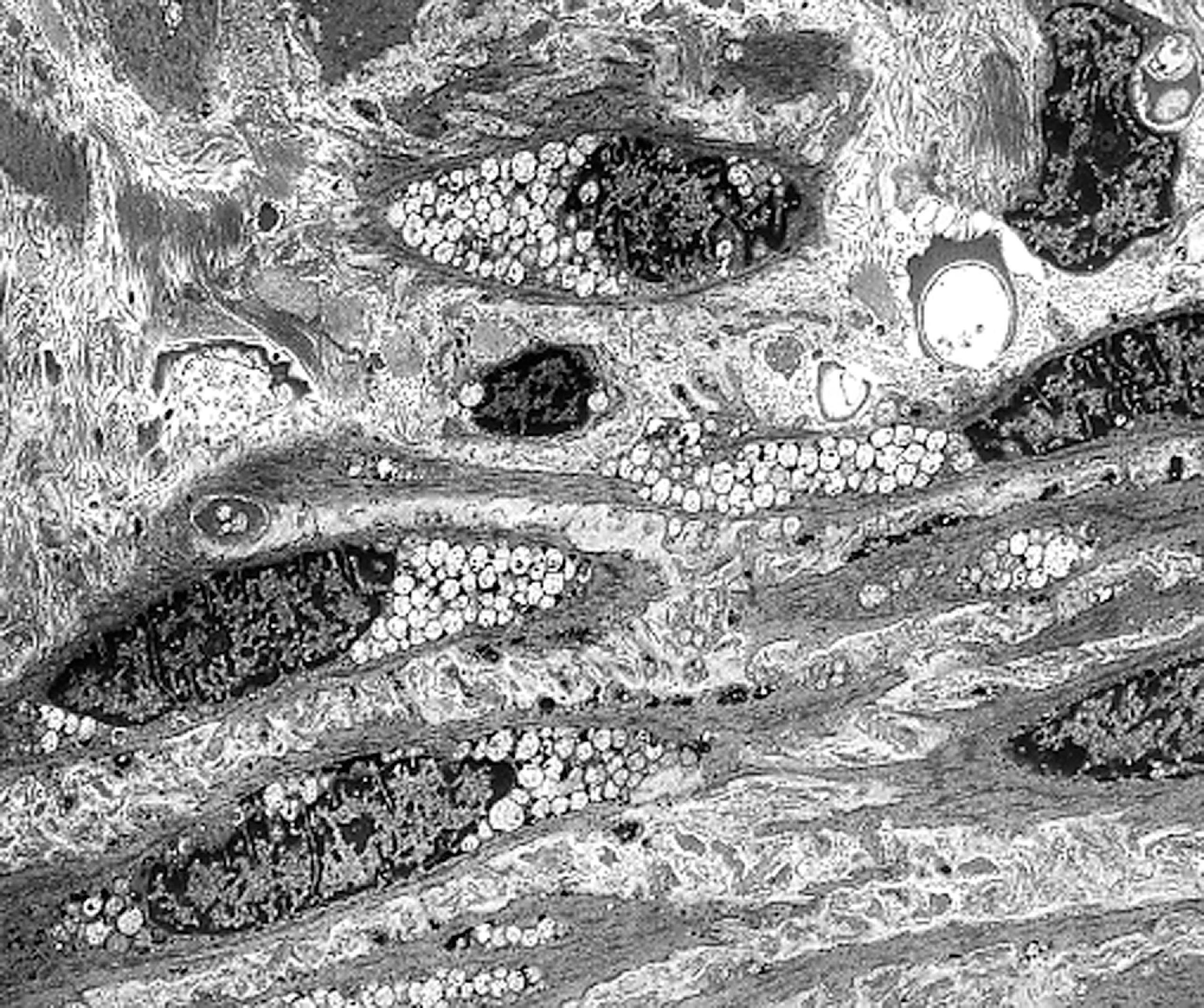 FIGure 8.24, Mucopolysaccharidosis-containing vacuoles in fibroblasts.