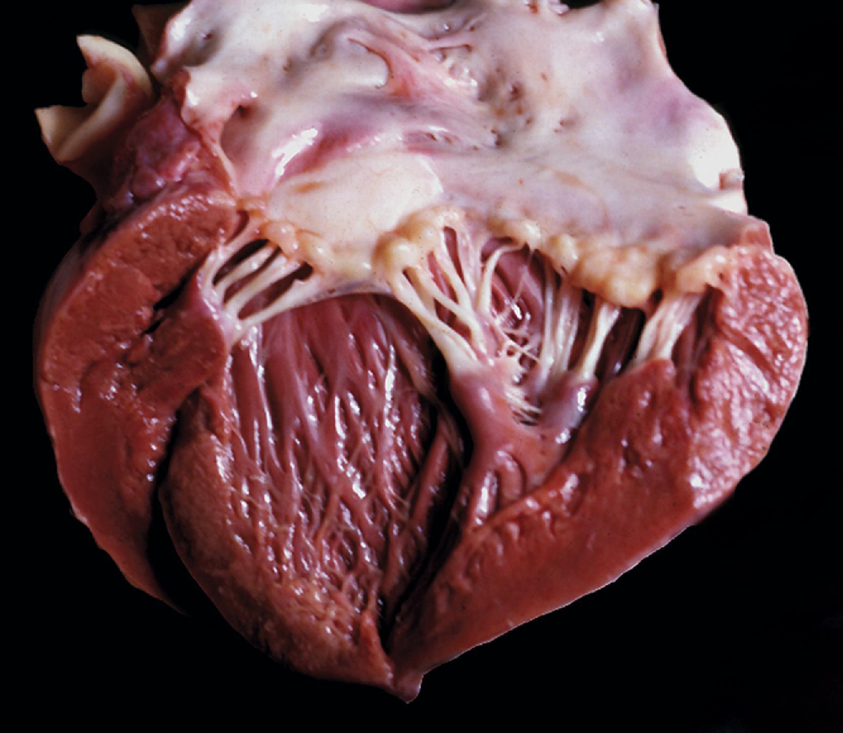 FIGure 8.25, Myocardial hypertrophy and thickening of endocardium, cardiac valves, and chordae tendineae in mucopolysaccharidosis.