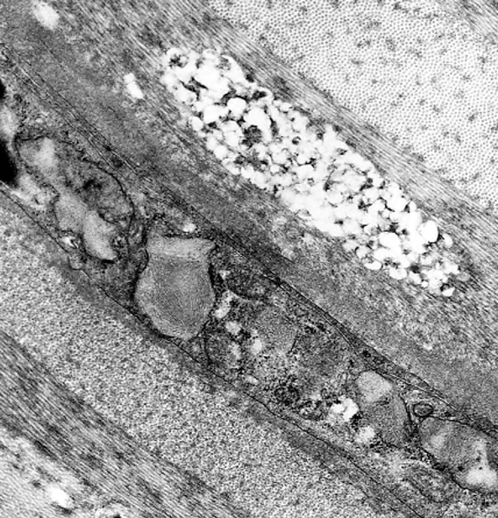 FIGure 8.27, Glycosaminoglycan storage in corneal fibroblasts in mucopolysaccharidosis.